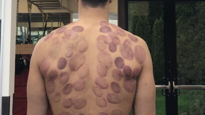 Enes Kanter koristi ‘cupping’ terapiju