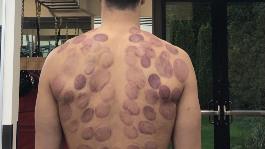 Enes Kanter koristi 'cupping' terapiju